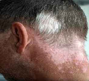 انواع قارچ پوستی با عکس