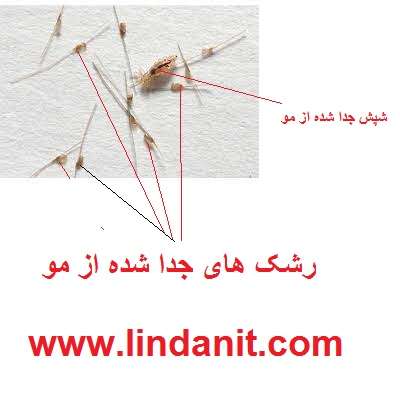 رشک جدا شده از مو
